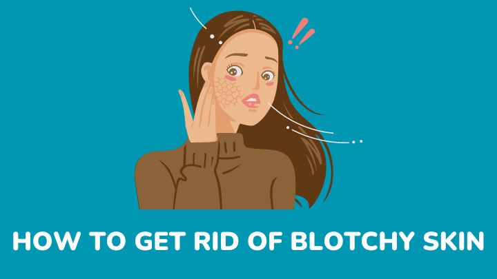 how to get rid of blotchy skin